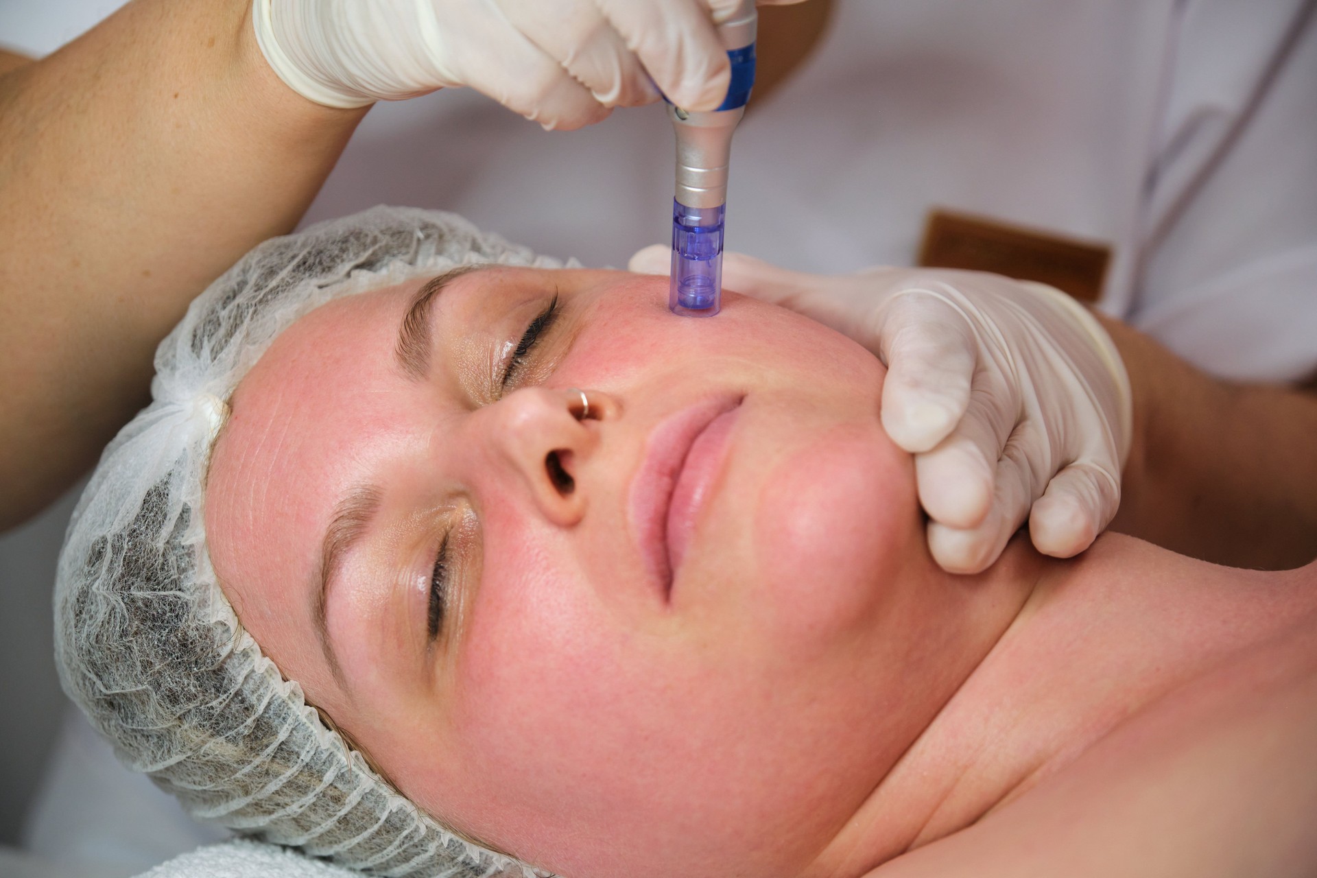 microneedling treatment on patient's face